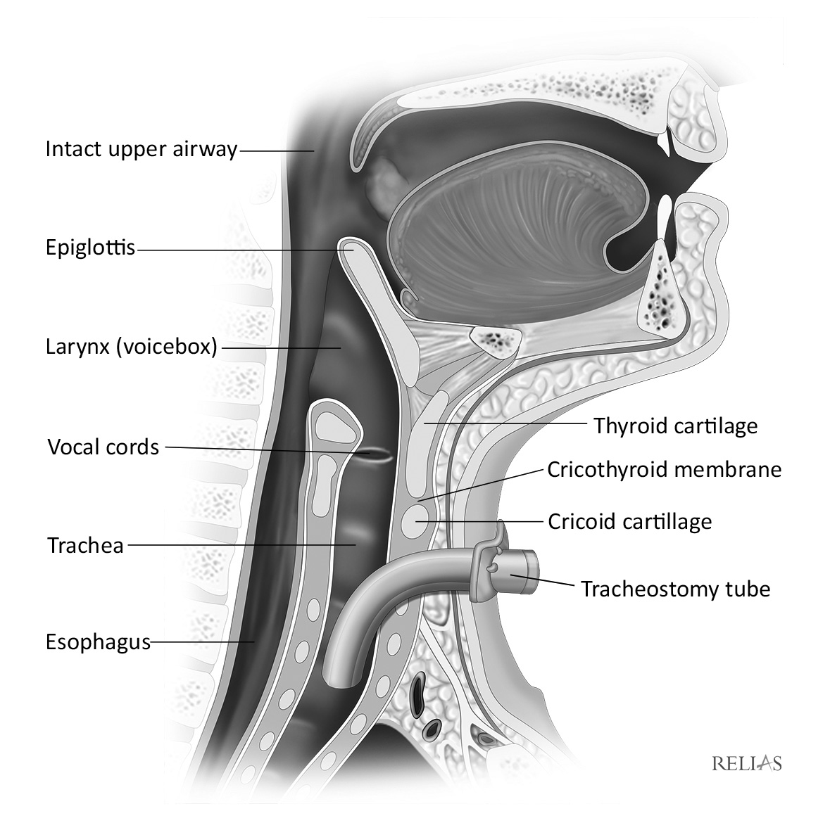 tracheostomy procedure anatomy