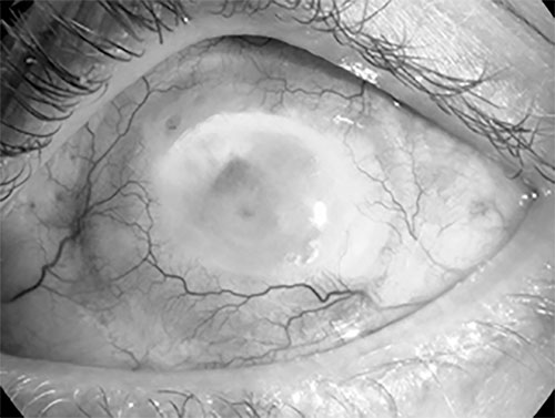TR050122 chemical eye injury web.jpg