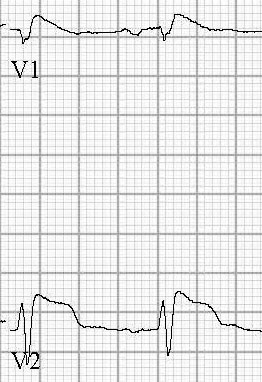 Figure 10a_New Figure 10a - Brugada Syndrome Type 1 BW.jpg