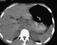 gallstones on CT