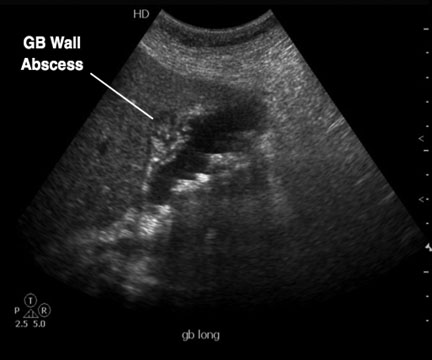 abscess in gallbladder wall