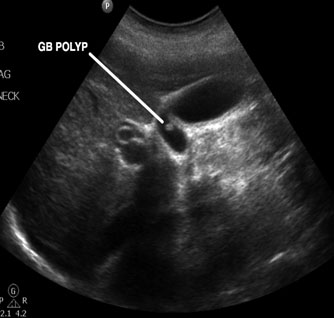 polyp within gallbladder