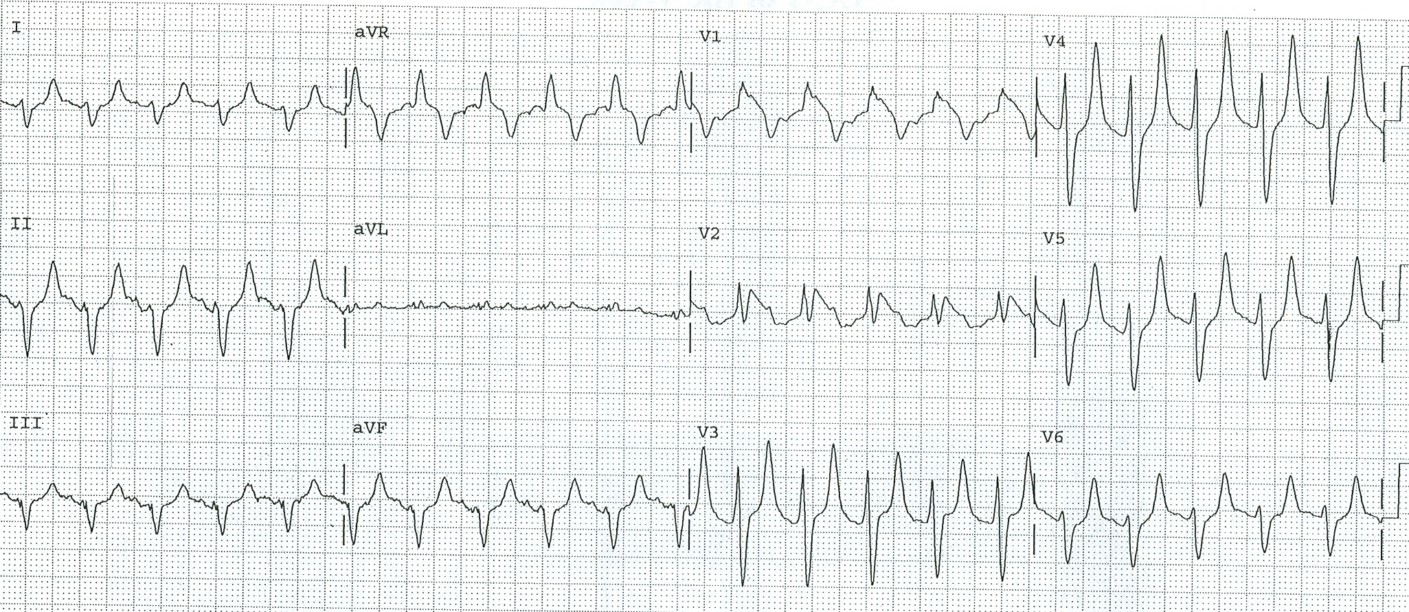 figure 5 hyperkalemia