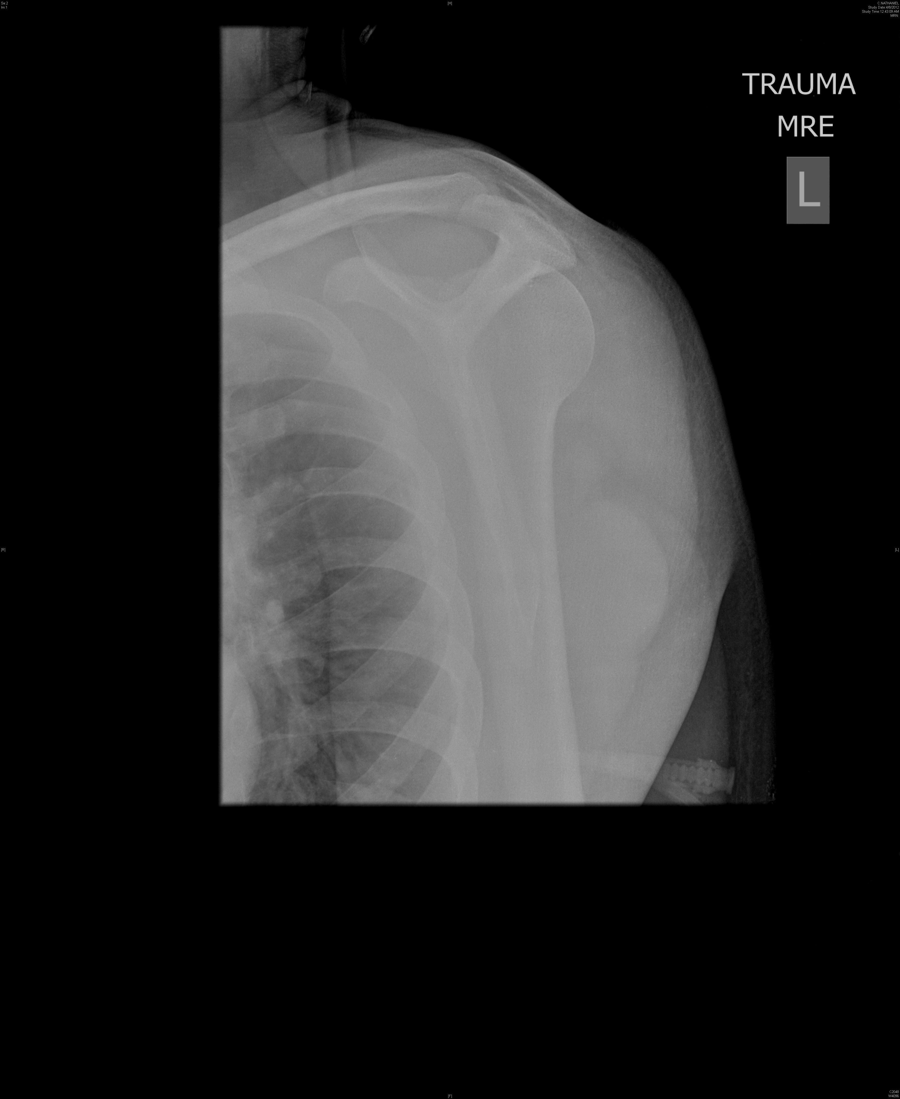 Posterior shoulder dislocation 2