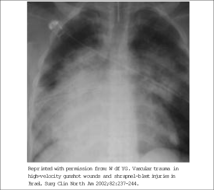 Figure 2. Blast Lung