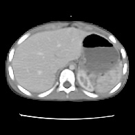 Figure 4. Spleen Fracture
