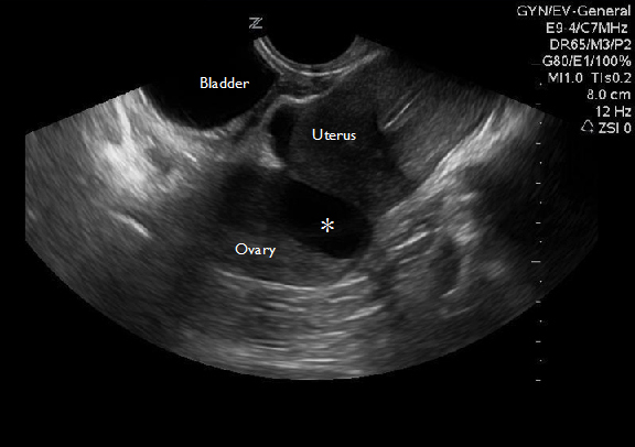 Figure 3A: Ovarian Torsion