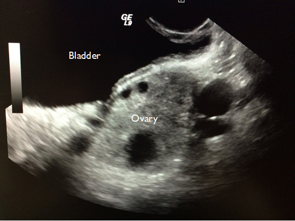 Figure 3B: Ovarian Torsion