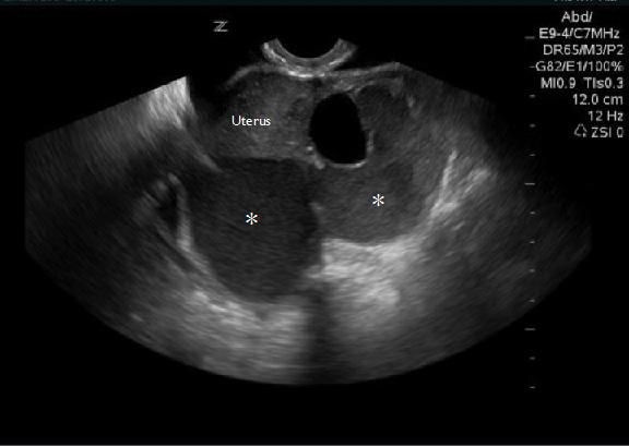 Figure 5: Endometrioma