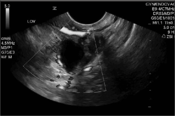 Figure 6A: Tubo-ovarian Abscess