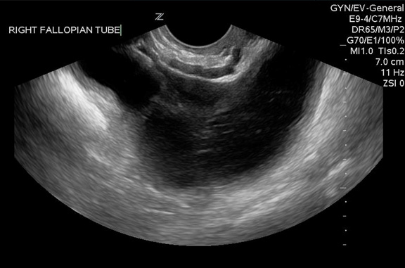 Figure 6B: Tubo-ovarian Abscess