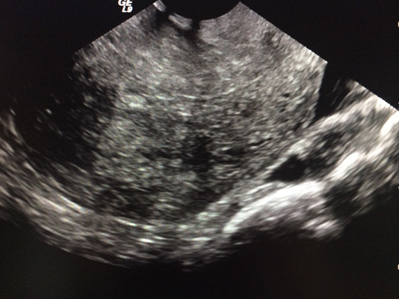 Figure 8: Adenomyosis