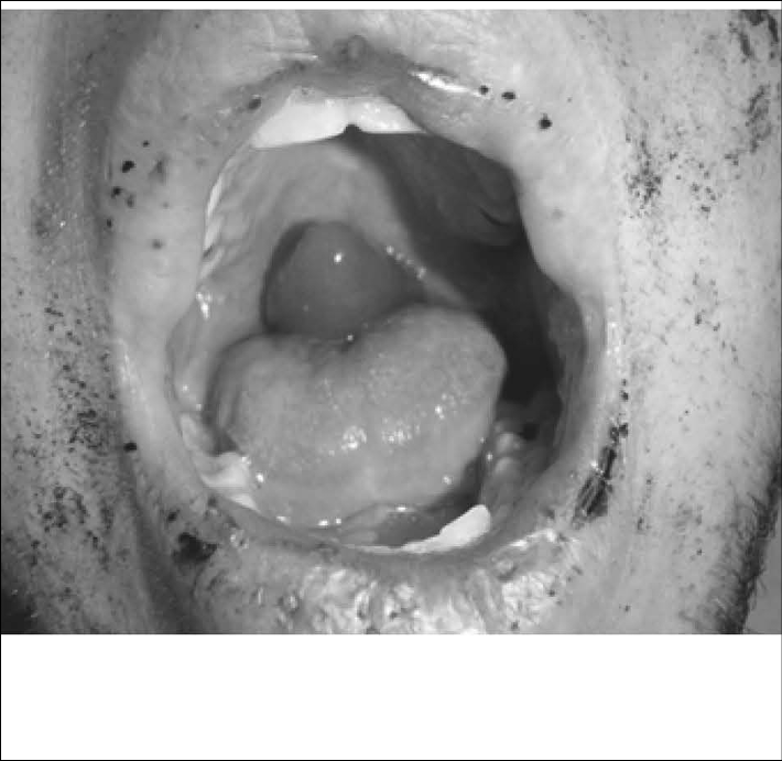 uvula-disease-fig-2.jpg