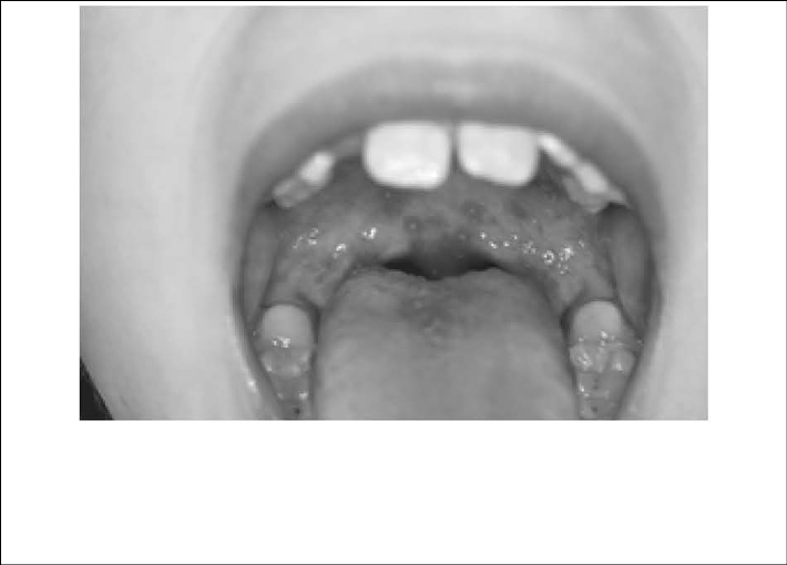 uvula-disease-fig-4.jpg