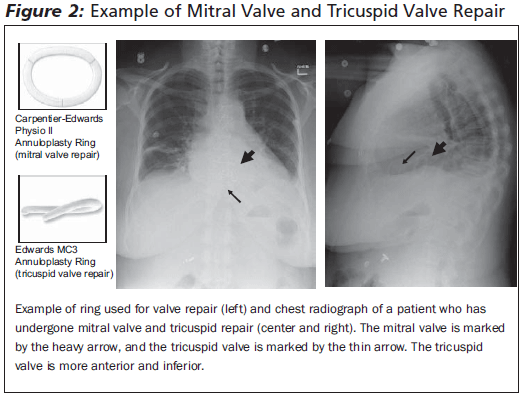 Complications Of Prosthetic Heart Valves In The Emergency Department