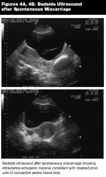 Passing clots/tissue after D&C (pic) - Miscarriage Support, Forums