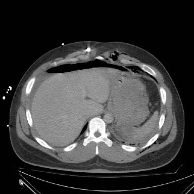 Figure 9a - hemoperitonuem.jpg
