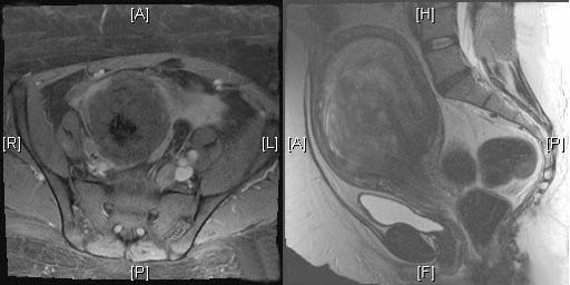 Figure_7_MRI_endometr_fibroid.jpg