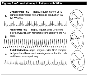 Ventricular Tachycardia Vs Rapid Atrial Fibrillation And Wpw Syndrome ...