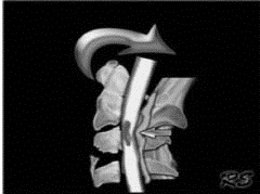 EMR061812 fig 11 illustration extension teardrop fracture.jpg