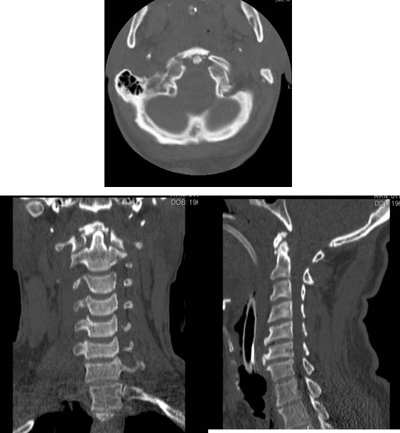 EMR061812 fig 7 CT Jefferson burst fracture.pdf