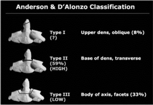 EMR061812 fig 8 Odontoid classification.jpg