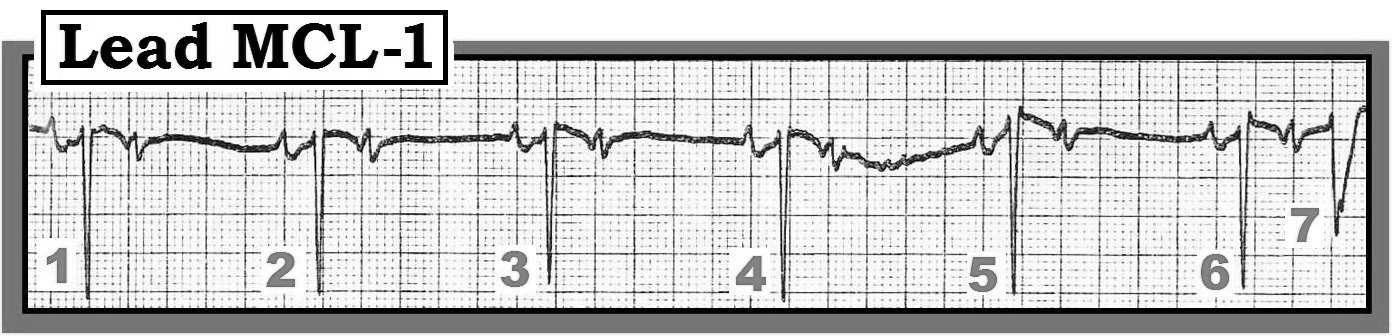 Figure — Lead MCL-1 rhythm strip. Is this Mobitz I or Mobitz II?