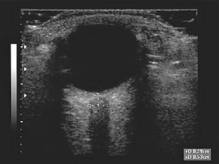 EMR022811fig20 dilated optic nerve sheath_0001.jpg