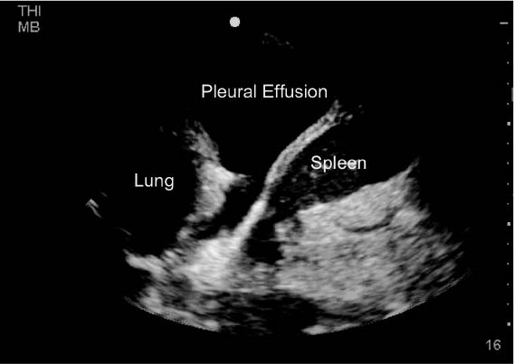 EMR022811fig6 lung parenchyma pleural effusion_0001.jpg