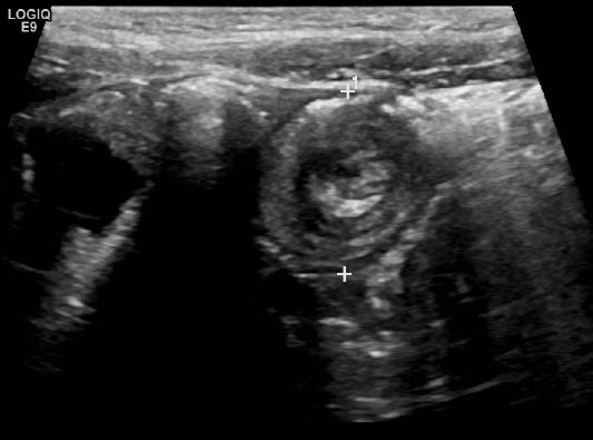 EMR062011 fig 1 Intussusception on ultrasound with target sign.bmp