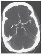 EMR 032811 CT angiographic image.pdf