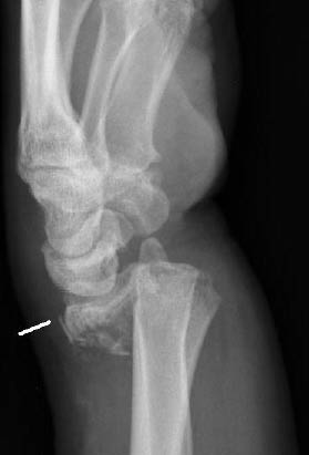 EMR 112111 fig 10 Colles fracture.jpg