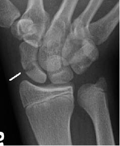 EMR 112111 fig 3 scaphoid fracture.jpg