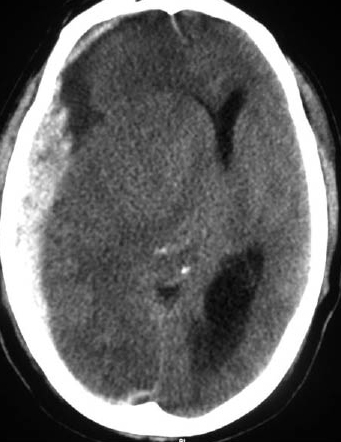 Figure 2 - Subdural hematoma.jpg