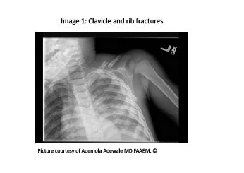 Figure 3 clavical fracture.pdf