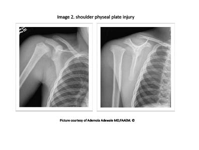 Figure 4 physeal plate injury.pdf