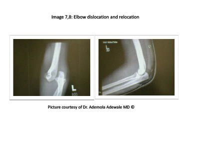 PDMR 0711 figure 10 elbow dislocation.pdf