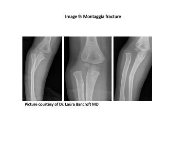 PDMR 0711 figure 11 Montaggia fracture.pdf