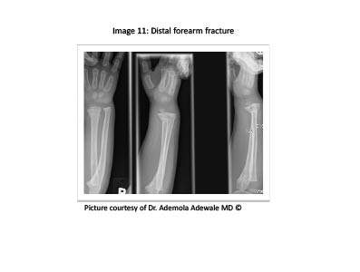 PDMR 0711 figure 12 distal forearm fracture.pdf