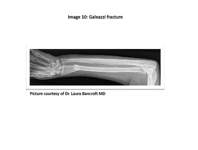 PDMR 0711 figure 14 Galeazzi fracture.pdf