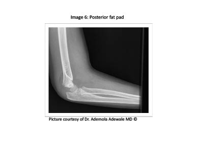 PDMR 0711 figure 8 posterior fat pad.pdf
