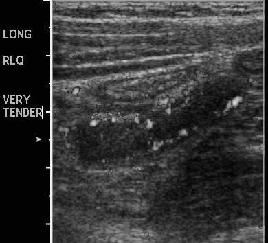 PDMR 1011 appendicitis ultrasound BW_0001.jpg