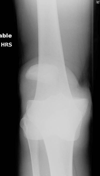 TR0701fig 2 b anterior knee dislocation.pdf