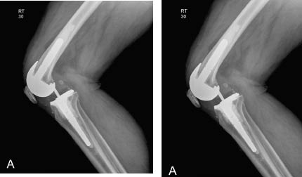 TR0701fig 3 a anterior prosthetic dislocation.pdf