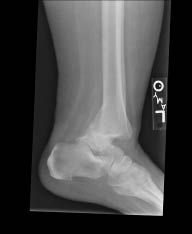 EMR elderly trauma ankle fracture dislocation.pdf
