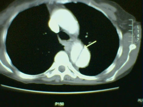 EMR elderly trauma aortic dissection.pdf