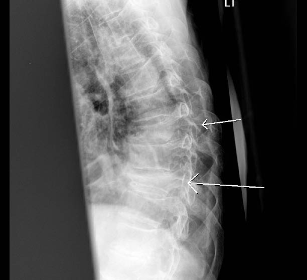 EMR elderly trauma thoracic spine fracture.pdf