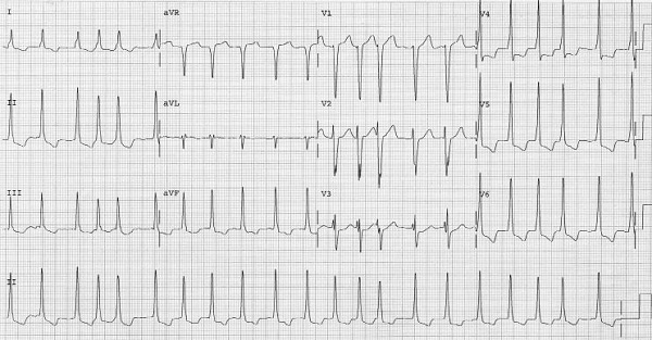 Afib in WPW rate 131 cropped.jpg