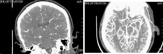 neurologic fig2 CT angiogram of right MCA stroke.pdf