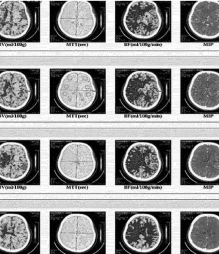 neurologic fig3 CT perfusion right MCA stroke.jpg